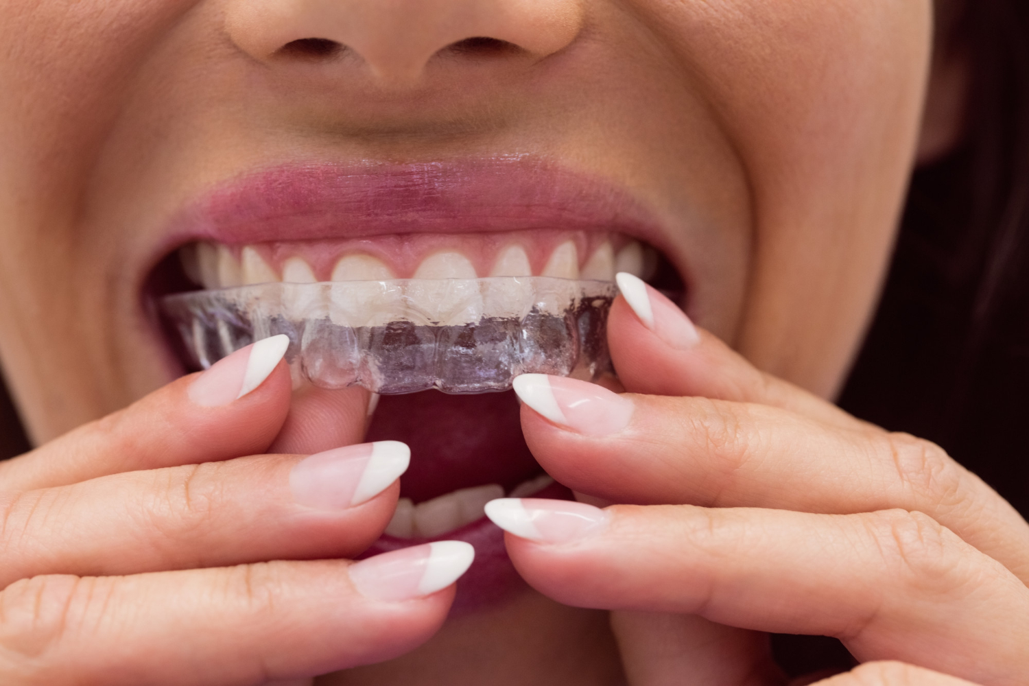 Dental splint adjustment
